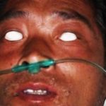 &iquest;Qu&eacute; es la teleterapia en medicina nuclear?
